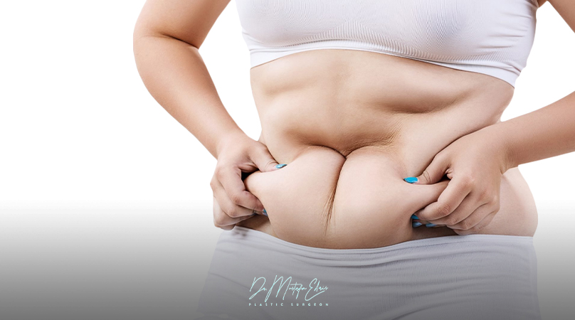 تجميل البطن بعد الولادة | تخلصي من الترهلات واحصلي على قوام مثالي