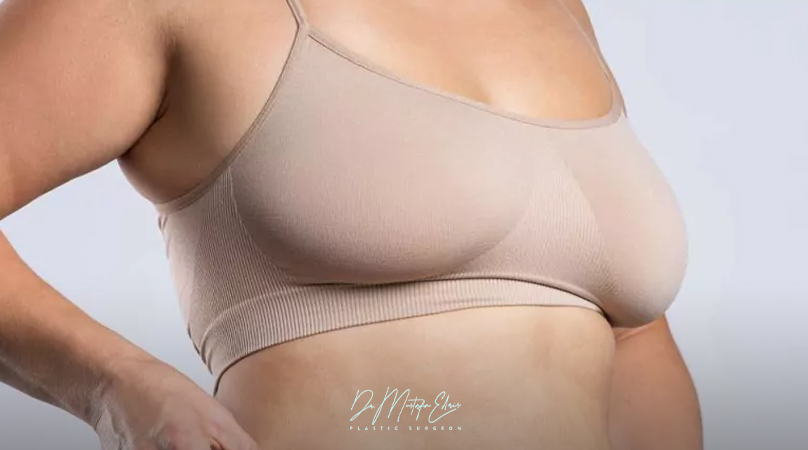 كل ما تريدين معرفته عن علاج ترهل الثدي بعد التكميم جراحيًا