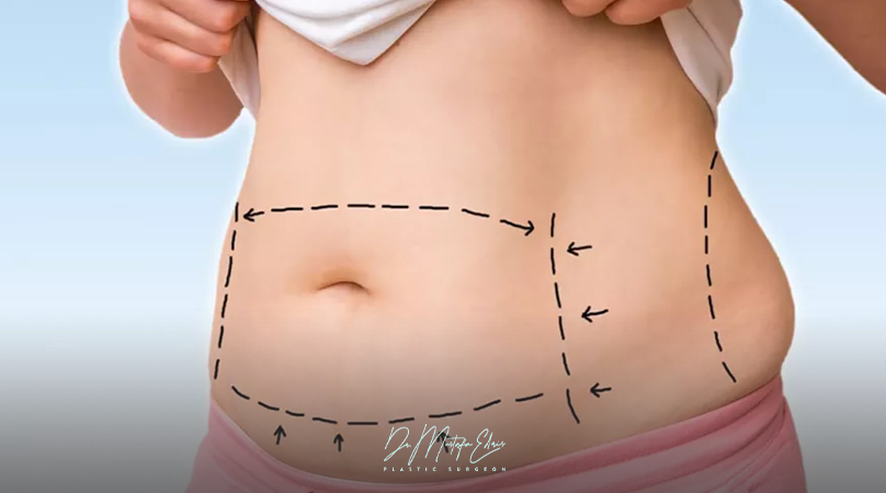 عملية شفط الدهون بالليزر – الطريقة الافضل للتخلص من الدهون