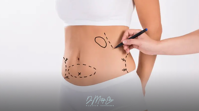 نحت الجسم بدون جراحة في مصر | دليل شامل لعام