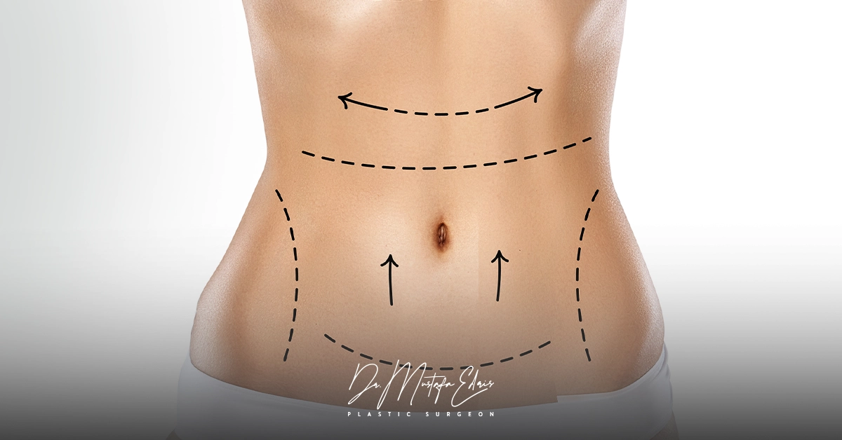 ما هي عملية مامي ميك اوفر Mommy Makeover؟
