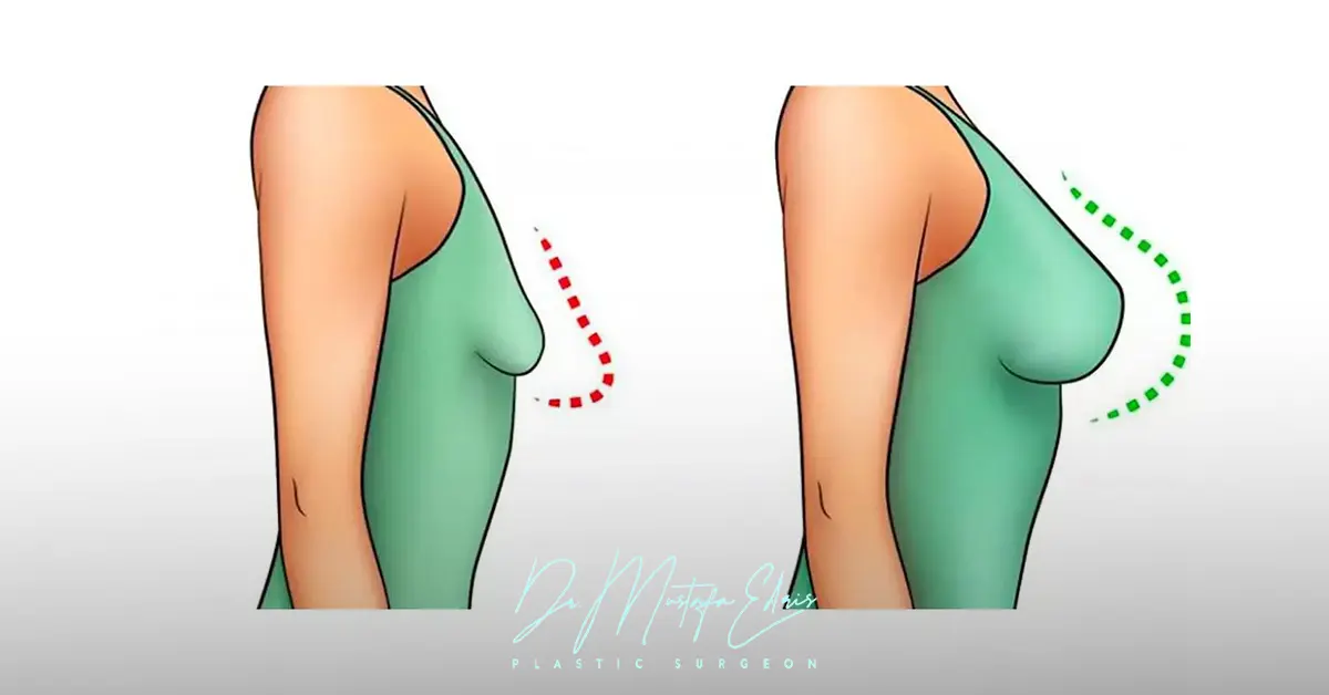 عملية تكبير الثدي بالليزر