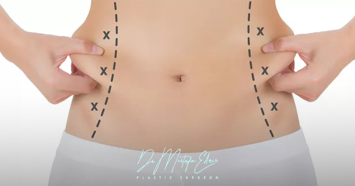 تجربتي مع شفط الدهون بالفيزر