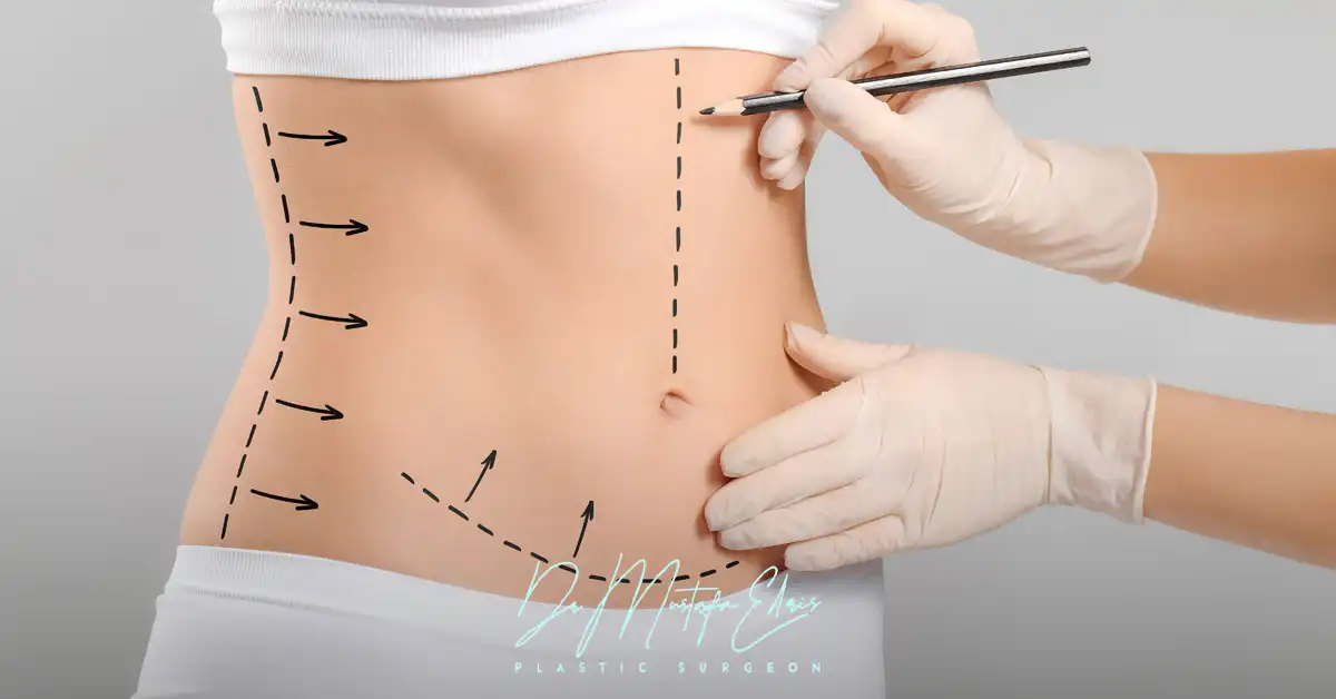 افضل دكتور شفط دهون بالفيزر في مصر