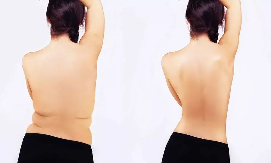 شفط دهون الظهر