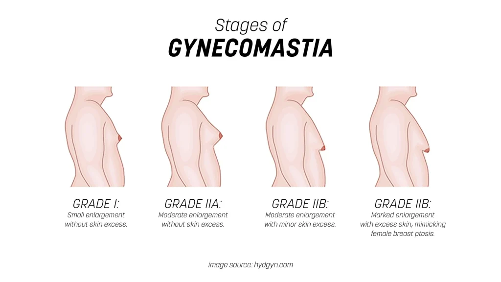 درجات التثدي عند الرجال