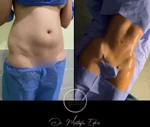 نحت الجسم قبل وبعد